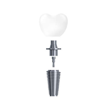 3d realistic illustration of dental tooth implant and its parts. Concept of tooth health and dental. Vector icon isolated on white backgroundのイラスト素材