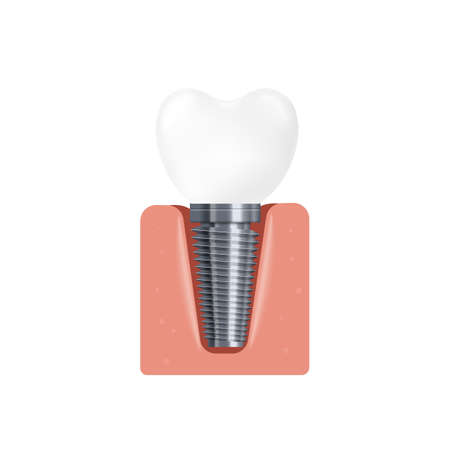 Realistic 3d isolated vector illustration of a dental implant. Construction of a dental implant in...