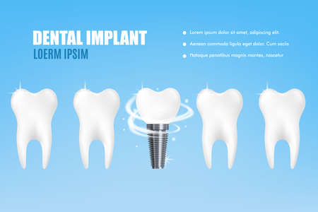 Dental implant poster - realistic mockup of tooth replacement ad poster. White teeth with one...
