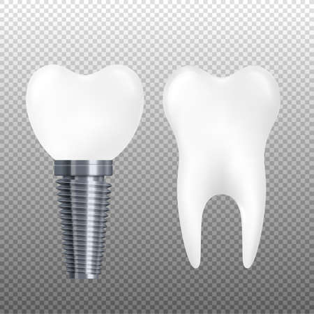 Realistic dental implant and healthy tooth isolated on transparent background. Ceramic crown on metal screw and white molar with roots, vector illustration.のイラスト素材