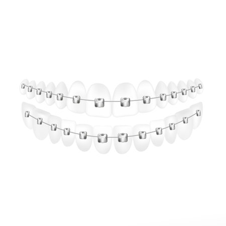 Teeth with dental braces for alignment, realistic vector illustration isolated.のイラスト素材