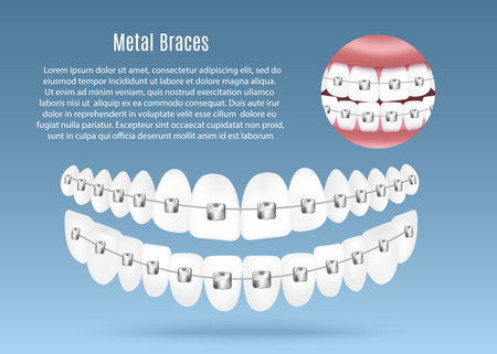 Metal dental teeth braces banner mockup, realistic vector illustration.のイラスト素材