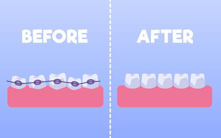 Teeth before and after braces flat style, vector illustrationのイラスト素材