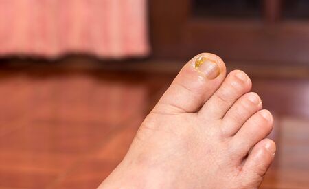 Nail sores on the toes,healthy and healthcare conceptの写真素材