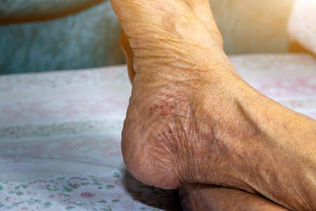 Leg of the elderly person to check for symptoms of illness,health care conceptの写真素材