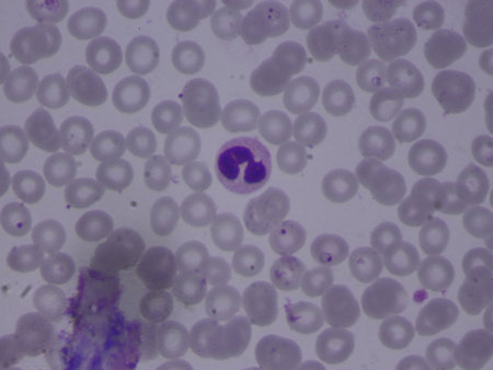 Malaria infected red blood cells