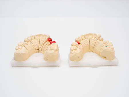 Plaster model or cast of human teeth. Teeth model on a white background.の写真素材