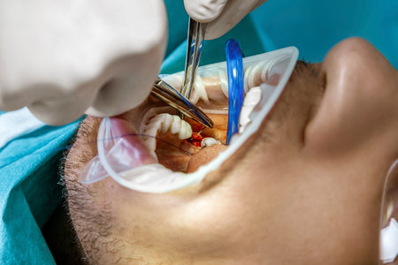 Close-up shot of attentive doctors performing surgical operation installing dental implants into...