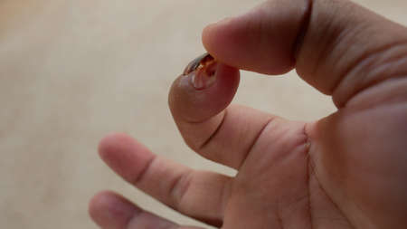 The accident left the fingers and nails torn and bruised, causing pain and requiring medical...
