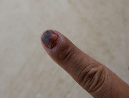 The accident left the fingers and nails torn and bruised, causing pain and requiring medical assistance.の写真素材