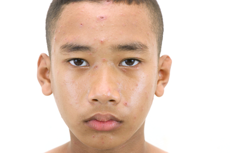 Varicella zoster virus or Chickenpox bubble rash on a boy.の写真素材
