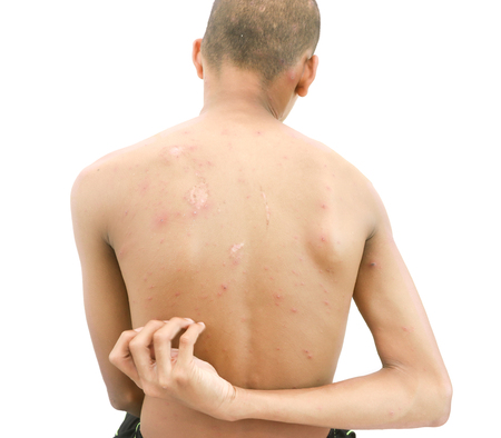 Varicella zoster virus or Chickenpox bubble rash on a boy.