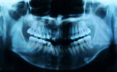 X-rays of the teeth.の写真素材