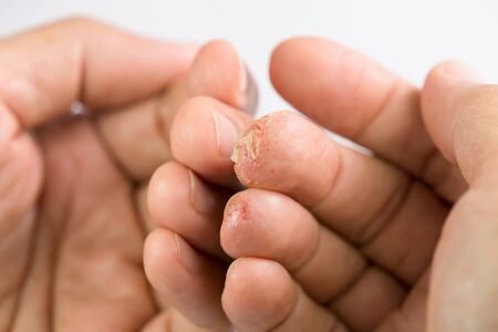 Advanced stage of dyshidrosis on fingers,cracked and peeling skin compare with normal fingers.Skin allergy problem, blisters filled with fluid and itchy.の写真素材