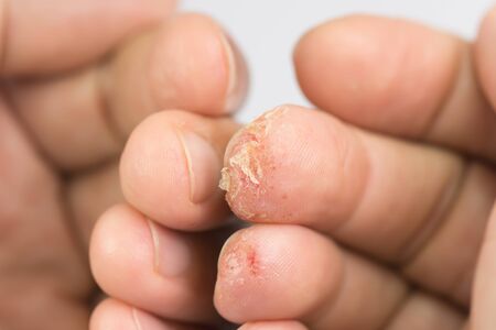 Advanced stage of dyshidrosis on fingers,cracked and peeling skin compare with normal fingers.Close up of skin allergy problem, blisters filled with fluid and itchy.の写真素材