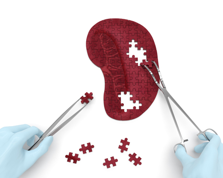 Spleen puzzle concept: hands of surgeon with surgical instruments tools performs spleen surgery as a result of splenomegaly, splenic infarction, megalosplenia, splenelcosis, splenitis, anemia, cystsの写真素材