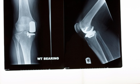 A x-ray of a partial  knee replacement の写真素材
