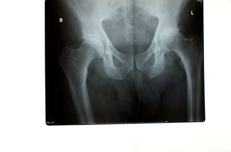 A xray of a hip indicating right and left side
