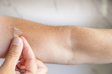 Exfoliation of the skin after sunburn. Man peeling off skin on his arm. The skin peels off, burnt...