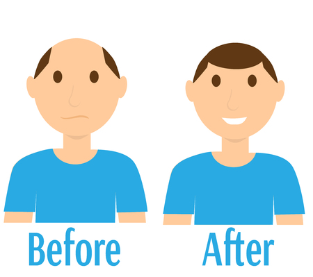 Before and after hair transplantationのイラスト素材
