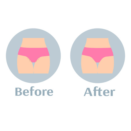 Before and after depilation bikini zoneのイラスト素材