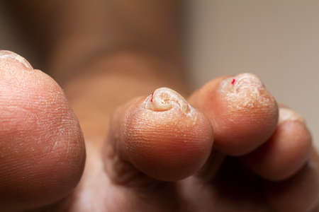Closeup of the legs of a woman suffering from chronic psoriasis on a white background. Closeup of rash and scaling on the patient's skin. Dermatological problems. Dry skin.の写真素材