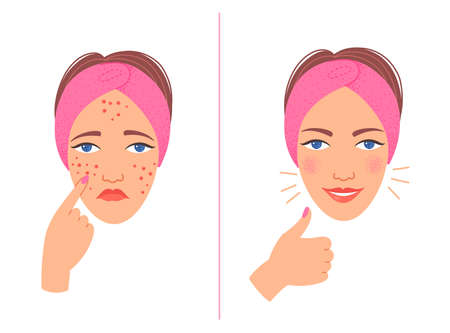 Acne treatment before after cartoon illustration.のイラスト素材