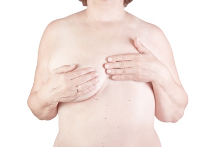 Breast cancer, breast removed on a white backgroundの写真素材