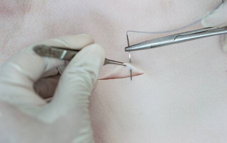 Medical procedure &quot,Suturing skin&quot,.の写真素材
