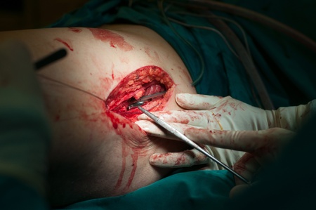 Orthopedic surgical procedure close up view.の写真素材