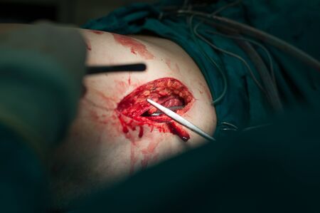Orthopedic surgical procedure close up view.の写真素材