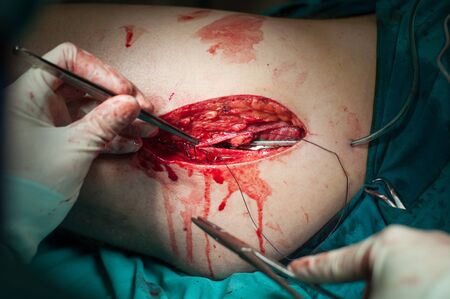 Orthopedic surgical procedure close up view.の写真素材