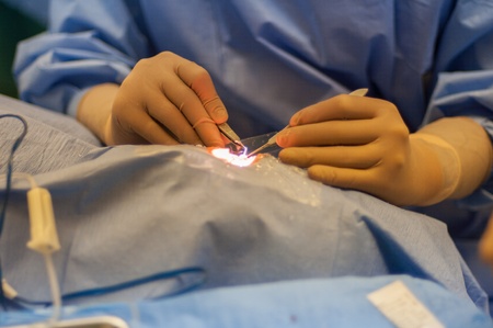 KO SAMUI, THAILAND - APRIL 5: 100 cataract patients operation royal medical project, during doctor works on April 5, 2012 at ko samui, Thailand.のeditorial素材