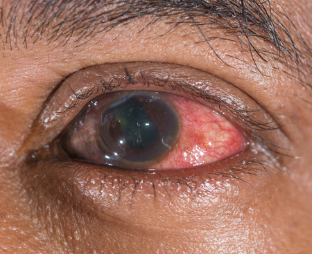 Close up of the traumatic eye ball ruptured during eye examination.
