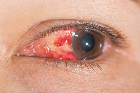 Close up of the Subconjunctival Hemorrhage during eye examination.の写真素材