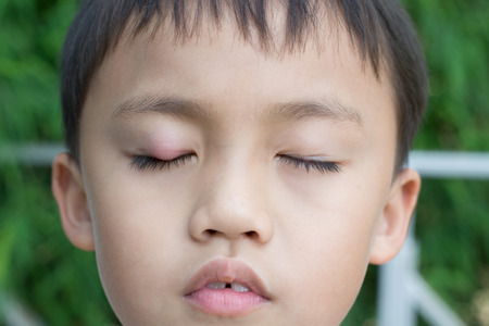 Right upper eye lid abscess "stye".の写真素材