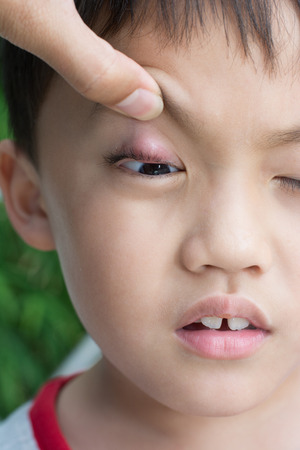 Right upper eye lid abscess "stye".の写真素材