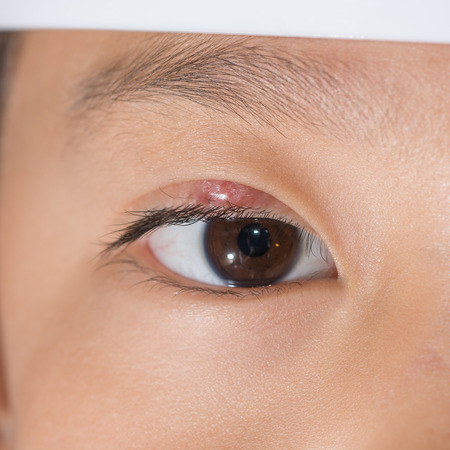 Right upper eye lid abscess "stye".の写真素材