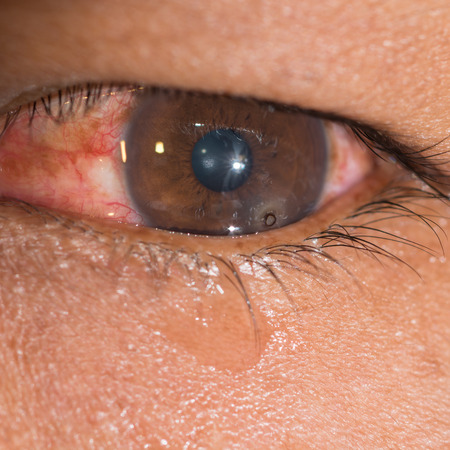 Close up of the metallic foreign body on cornea rust ring during eye examination.