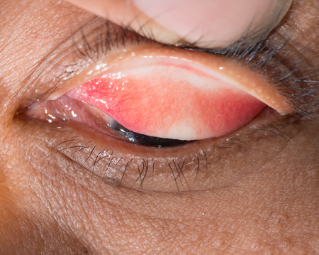 Close up of the eye during ophthalmic examination.