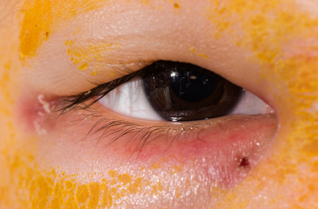 Close up of the periorbital ecchymosis during eye examination.の写真素材