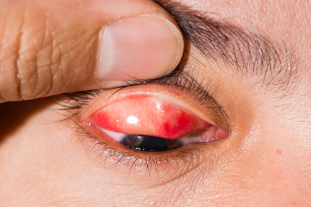 Close up of the chalasion during eye examination.
