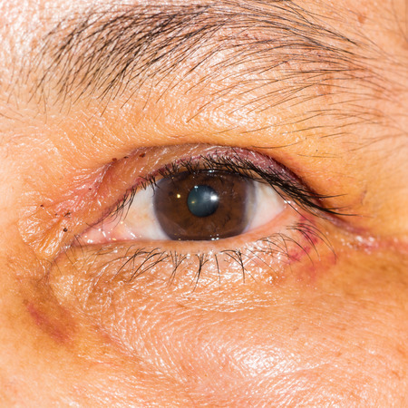 Close up of the post blepharoplasty during eye examination.の写真素材