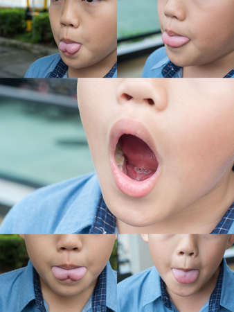 Asian boy with tongue tie, post operation.の写真素材