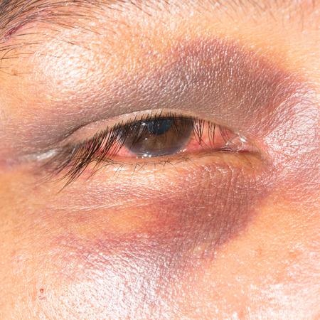close up of periorbital ecchymosis during eye examination.の写真素材