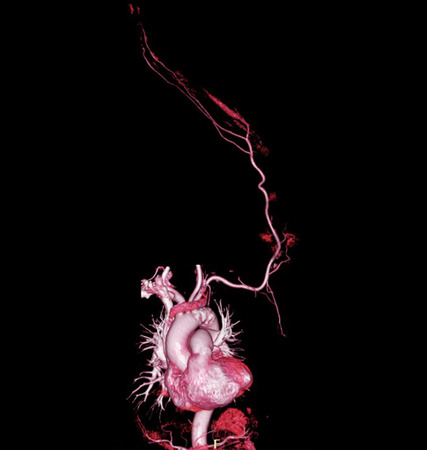 CTA brachial artery or CT scan of upper extremity or the Arm 3d rendering image with MIP technique.の写真素材