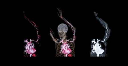 CTA brachial artery or CT scan of upper extremity or the Arm 3d rendering image.の写真素材