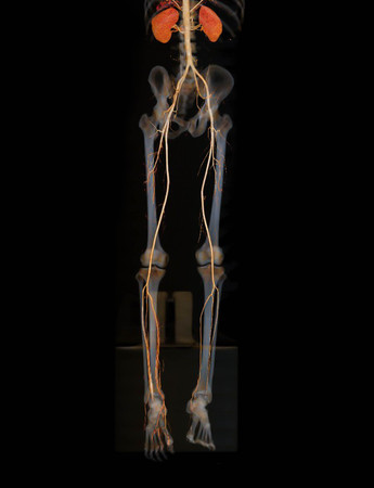 CTA femoral artery run off  3D rendering image of femoral artery woth kidney  from CT scanner.の写真素材