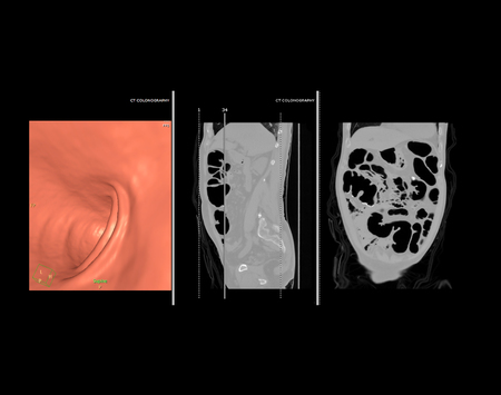 CT colonography or CT Scan of Colon 3D rendering image comparison with sagittal view vs Coronal view and on the screen.の写真素材