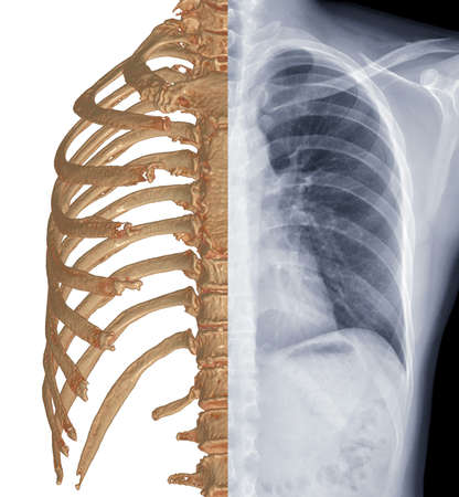 Compare CT  Chest  3D rendering and Chest x-ray .の素材 [FY310162989160]